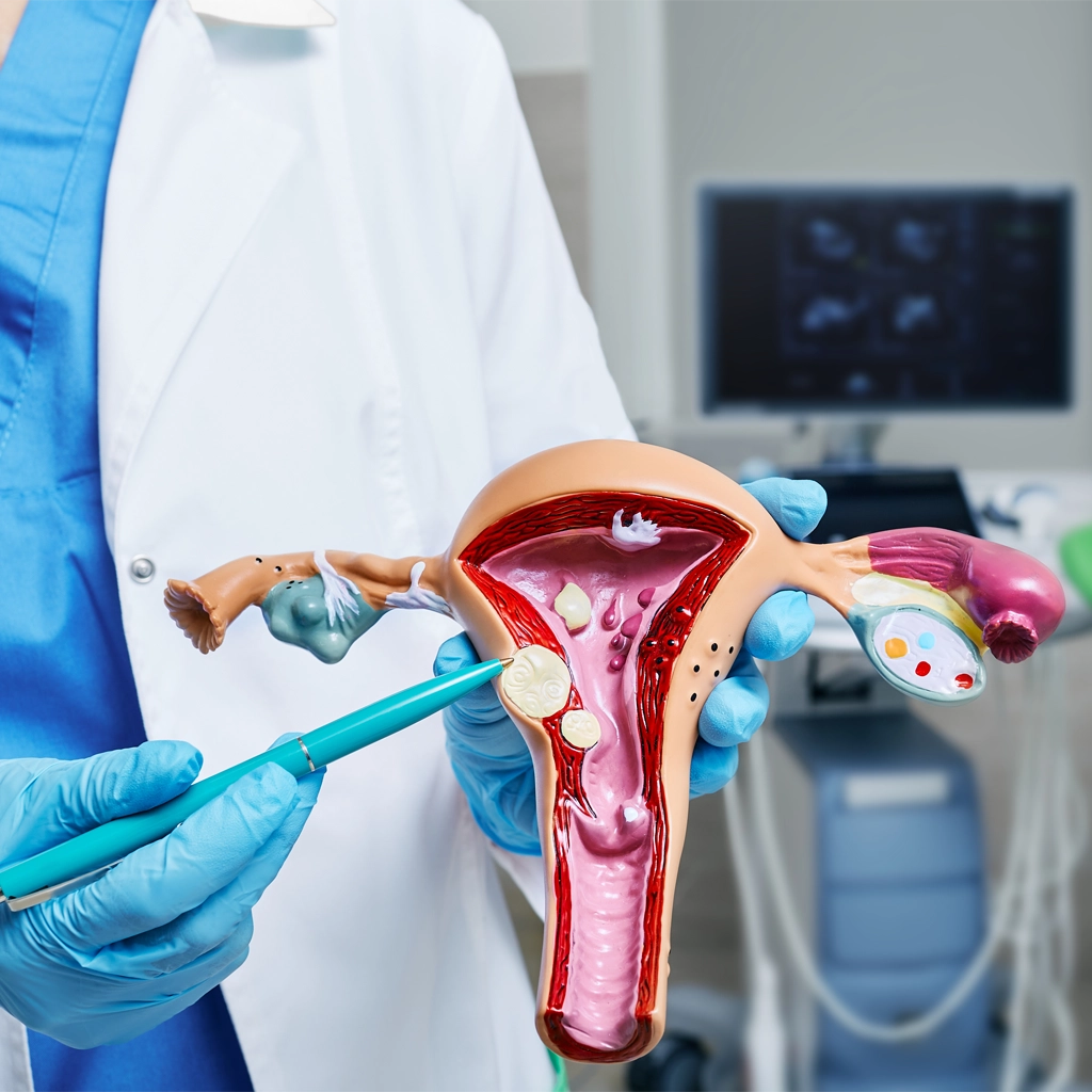 uterine fibroid treatment